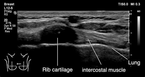 Free breast ultrasound near me | michael's blog