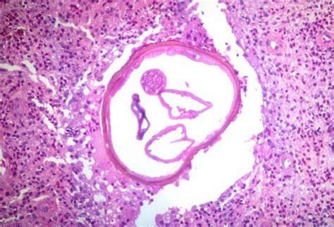 Onchocerca volvulus Life cycle, Morphology, Symptoms, Diagnosis and ...