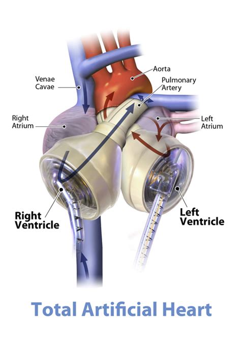 Home for Christmas with a total artificial heart | Royal Brompton & Harefield hospitals