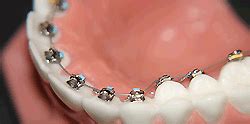 Lingual Braces Pros and Cons - Braces or Invisalign