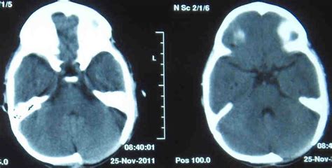 Postoperative images after craniectomy and drainage of empyema ...