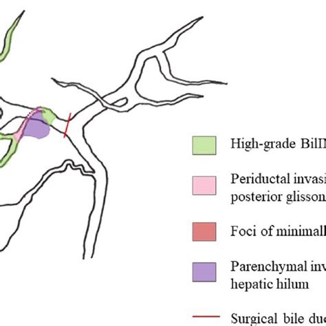 Schematic presentation of the distribution of the high-grade BilIN ...