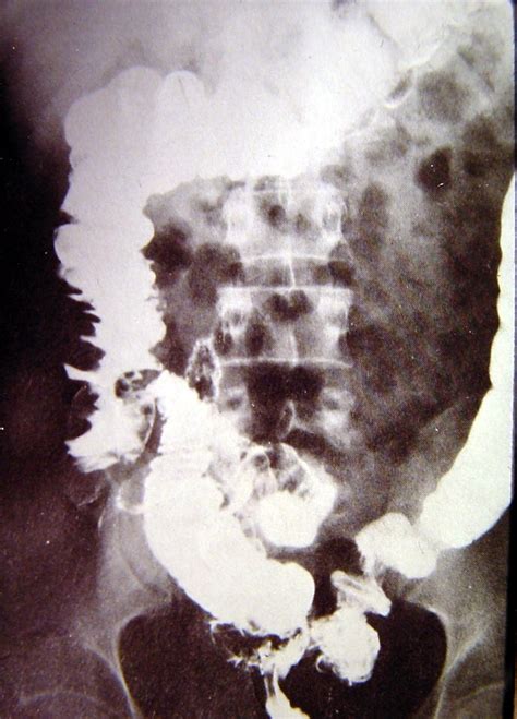 Colon Diverticular Disease 1823 Cecum Diverticulitis | Surgery Photos