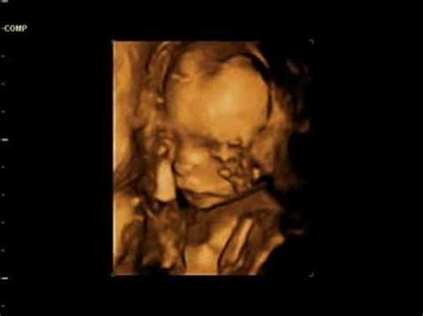 3D Ultrasound (20 Weeks Pregnant) - YouTube