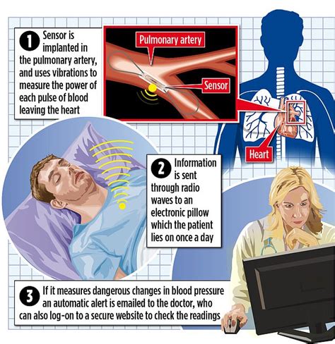 Tiny implant has been proven to HALF the number of hospital admissions for heart failure | Daily ...