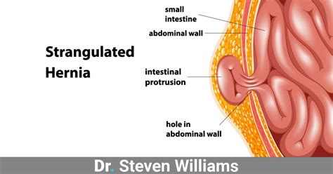 When It's Time For Hernia Surgery | Dr. Steven Williams in Boise