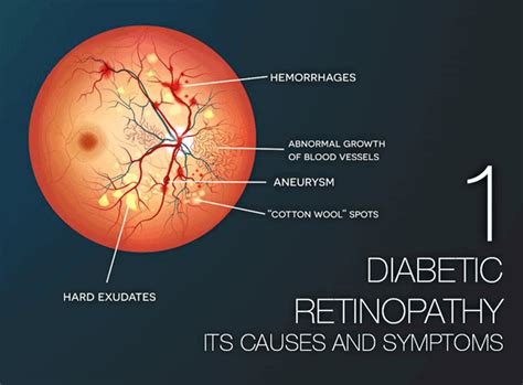 Diabetic Retinopathy Part 1: Its Causes and Symptoms | Fairfax VA | Vienna Eyecare Center