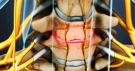 Deciding on Surgery for Cervical Degenerative Disc Disease