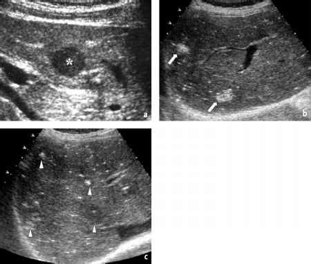 Epithelioid Hemangioendothelioma - MRI of the Liver