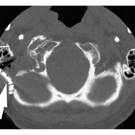 Axial CT image showing postoperative appearance. The hypoglossal canal ...