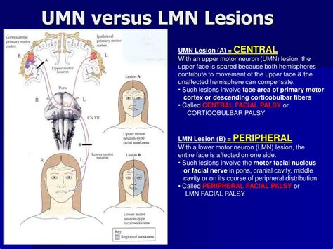 Difference Between Upper And Lower Motor Neuron Lesion Of Facial Nerve ...