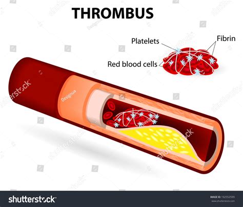 2,676 Platelet Abnormality Images, Stock Photos & Vectors | Shutterstock