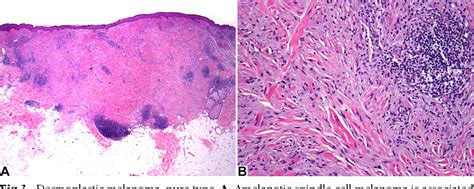 Figure 3 from Desmoplastic melanoma: a review. | Semantic Scholar