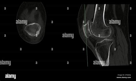 CT Scan of Knee joint sagittal and coronal in case fracture patella bone Stock Photo - Alamy