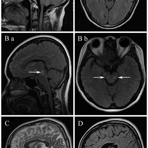 Brain Lesions Mri