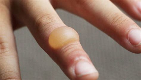 Burn blister: First aid, treatment, and types of burns