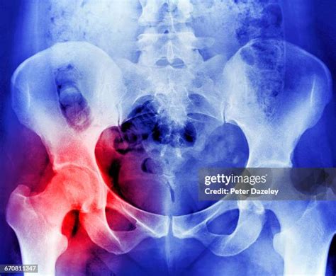 120 Hip Replacement Xray Stock Photos, High-Res Pictures, and Images - Getty Images