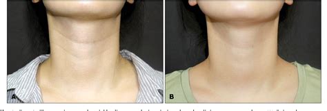 Figure 1 from Novel Treatment of Neck Wrinkles with an Intradermal Radiofrequency Device ...