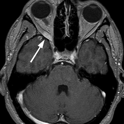 Recurrent Orbital Myositis Mimicking Sixth Nerve Palsy: Diagnosis with ...