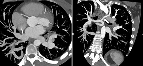 (a) The right middle and lower lobe pulmonary veins form a common... | Download Scientific Diagram