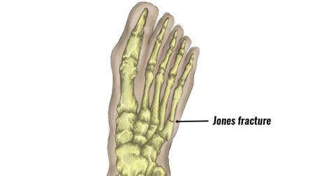 Jones Fracture - signs, symptoms, causes & treatment