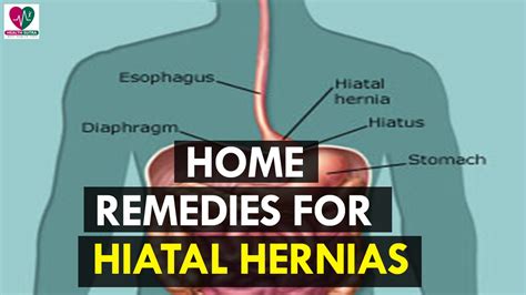 Home Remedies for Hiatal Hernias - Health Sutra - YouTube