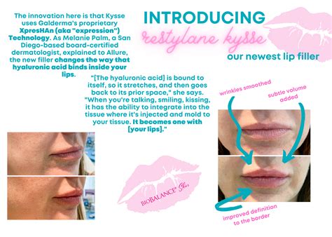 Introducing Our Newest Lip Filler: Restylane Kysse - BioBalance Skin