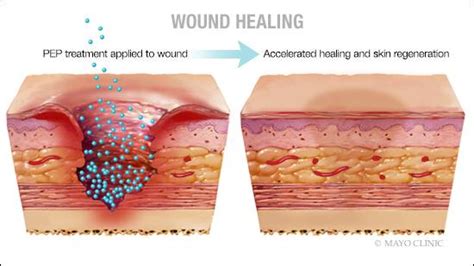 Mayo Clinic preclinical discovery triggers wound healing, skin regeneration - Mayo Clinic News ...