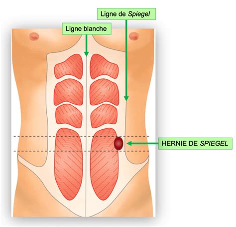 Qu'est-ce que c'est l'hernie de Spiegel ? - Dr méd. Vincent Ott (FMH)