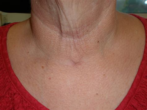 Minimally Invasive Thyroidectomy - Atlanta's Advanced Thyroid and Parathyroid Center