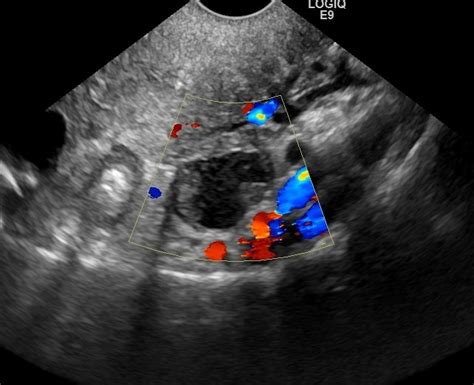 Pelvic Ultrasound in Houston for Ovarian Cancer Screening