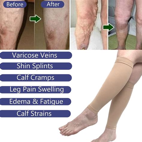 Compression Therapy For Cellulitis Prevention Lipedema, 49% OFF