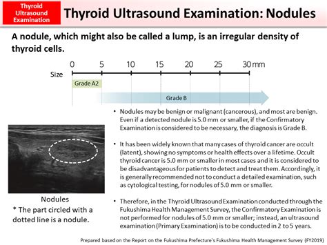 Thyroid Nodule Chart