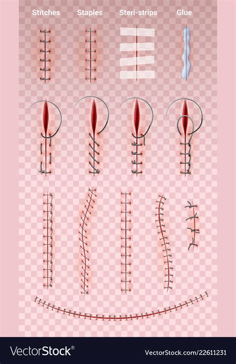 Surgical suture stitches set Royalty Free Vector Image