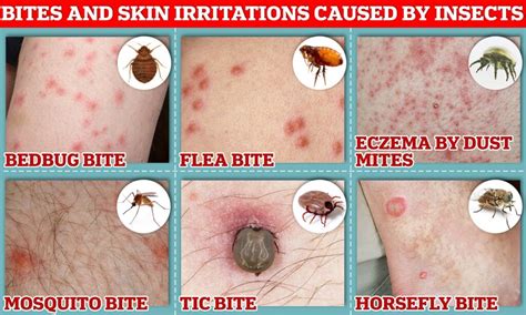 Beware of Bed Bug Bites: How They Can Aggravate Mite Infestations ...