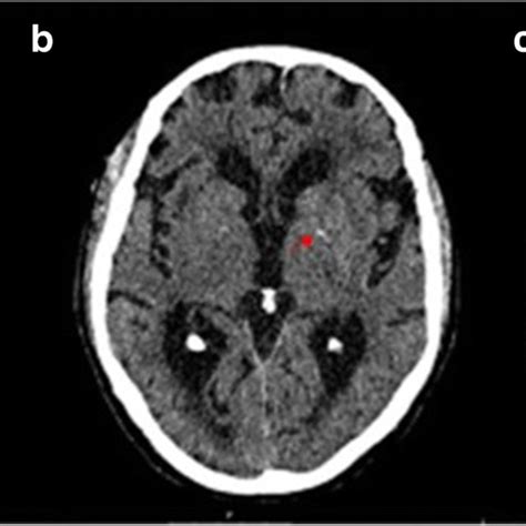 a CT scans with mild calcification in the right basal ganglia. b ...