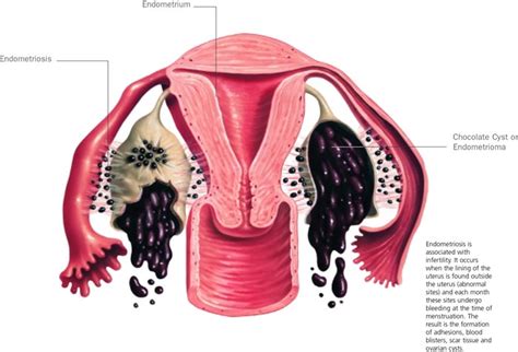 Causes - Endometriosis - Fertility & IVF - Coastal IVF , Sunshine Coast