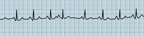 NCLEX Study Guide — COMMON CARDIAC RHYTHMS