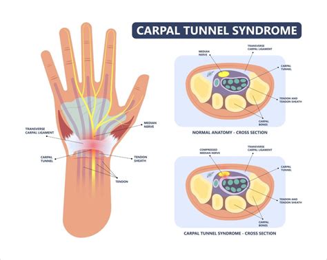 CARPAL TUNNEL SYNDROME & DISABILITY