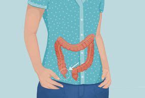 Appendix Rupture Causes, Symptoms, and Complications