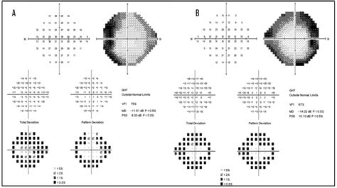 Autoimmune Retinopathy: A Review