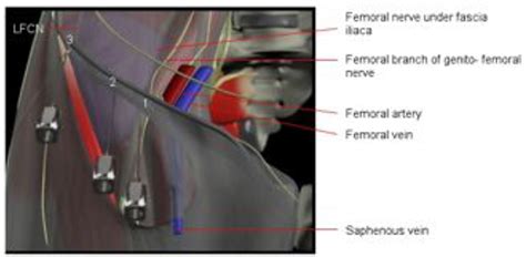 Fascia Iliaca Block Coverage