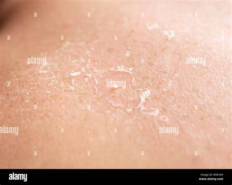 Sunburn Back Stock Photos & Sunburn Back Stock Images - Alamy