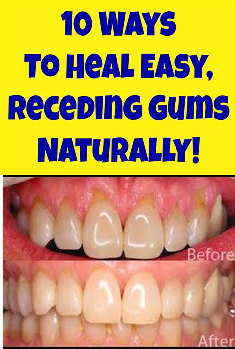 10 Ways To Heal Easy, Receding Gums Naturally! | Receding gums, Gum ...