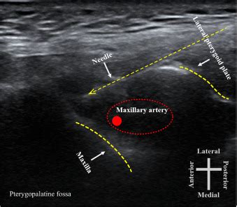 Preoperative Ultrasound-Guided Trigeminal Nerve Block in Orthognathic ...