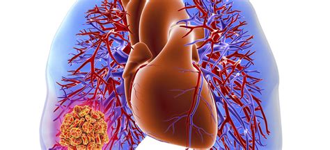 Inferior Vena Cava Filter | Conditions & Treatments | UT Southwestern Medical Center