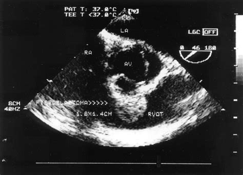 Clinical and Echocardiographic Characteristics of Papillary Fibroelastomas | Circulation