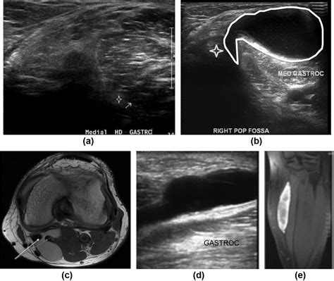 A diagnostic approach to popliteal fossa masses - Clinical Radiology