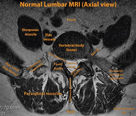 Healthcare Extreme How To Read An MRI Lumbar Spine In 8 Easy Steps in 2021 | Mri, Lumbar ...