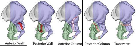 Transverse Process Fracture Orthobullets : Thoracolumbar Burst ...